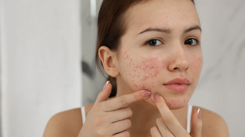 acne treatment