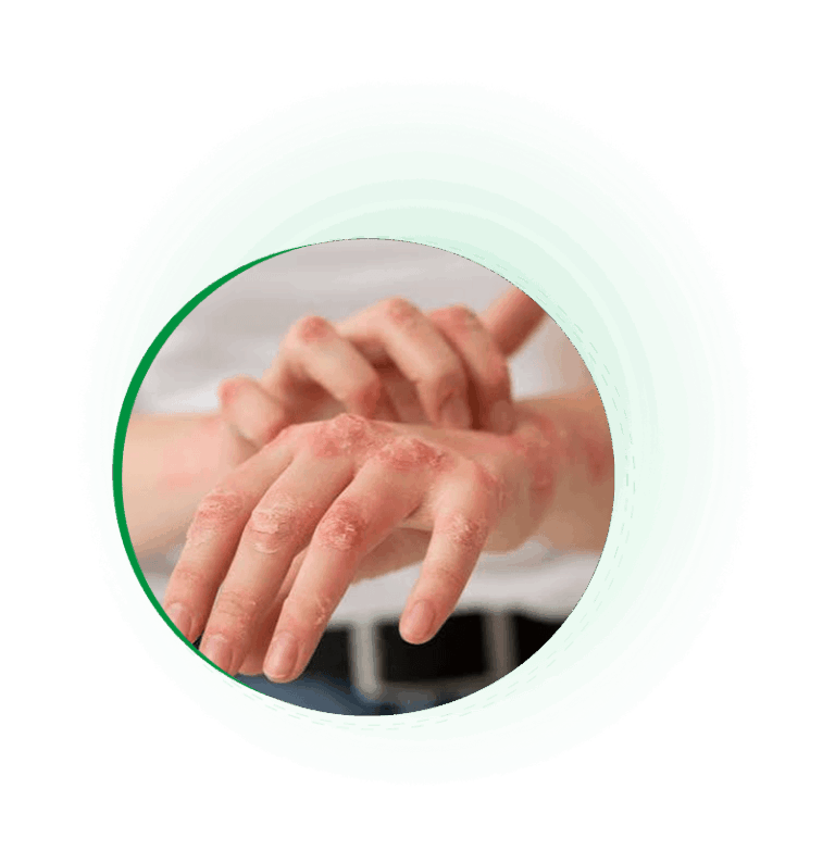Eczema